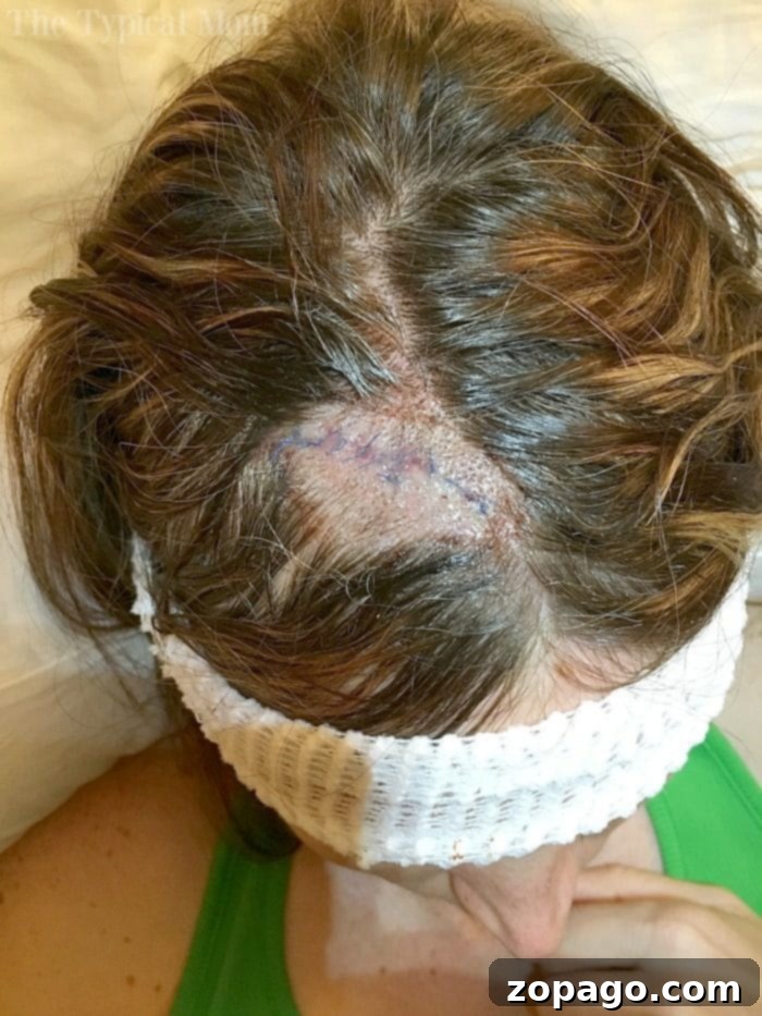 Basal Cell Carcinoma: Trust Your Gut and Be Your Own Health Advocate – My Mohs Surgery Journey Basal Cell Carcinoma Mohs Surgery Pictures