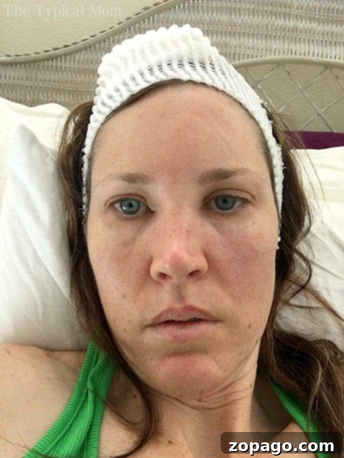 My Mohs Surgery Recovery: Trusting My Gut Led to Early Basal Cell Carcinoma Detection Mohs Surgery Scar Recovery Pictures